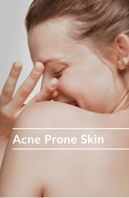 acne prone skin image
